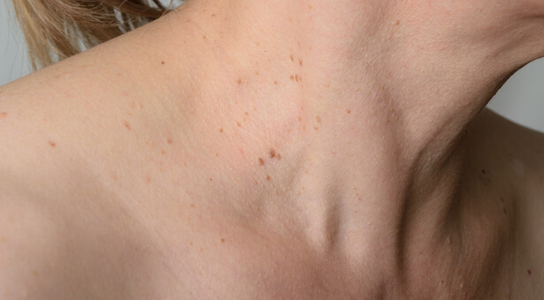 Une astuce simple pour se débarrasser des taches brunes sur la peau, également appelées taches de vieillesse ! ➤ Buzzday.info