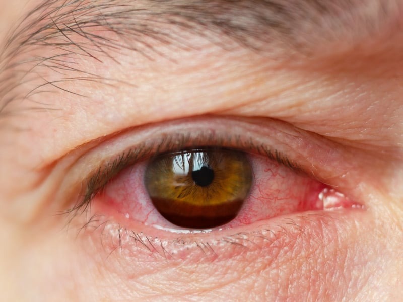 This woman’s eye infection was scarier: ‘I could see them moving around in my eye.