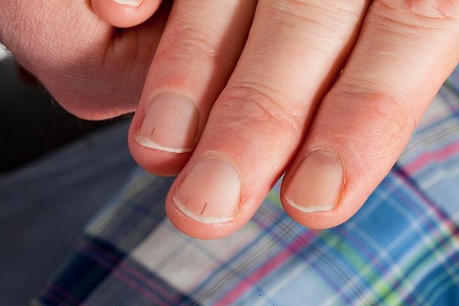 “Linia śmierci” na paznokciu. Obecność takiej plamki może być objawem śmiertelnej choroby ➤ Buzzday.info