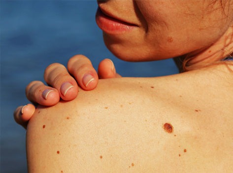 Primary signs of skin cancer