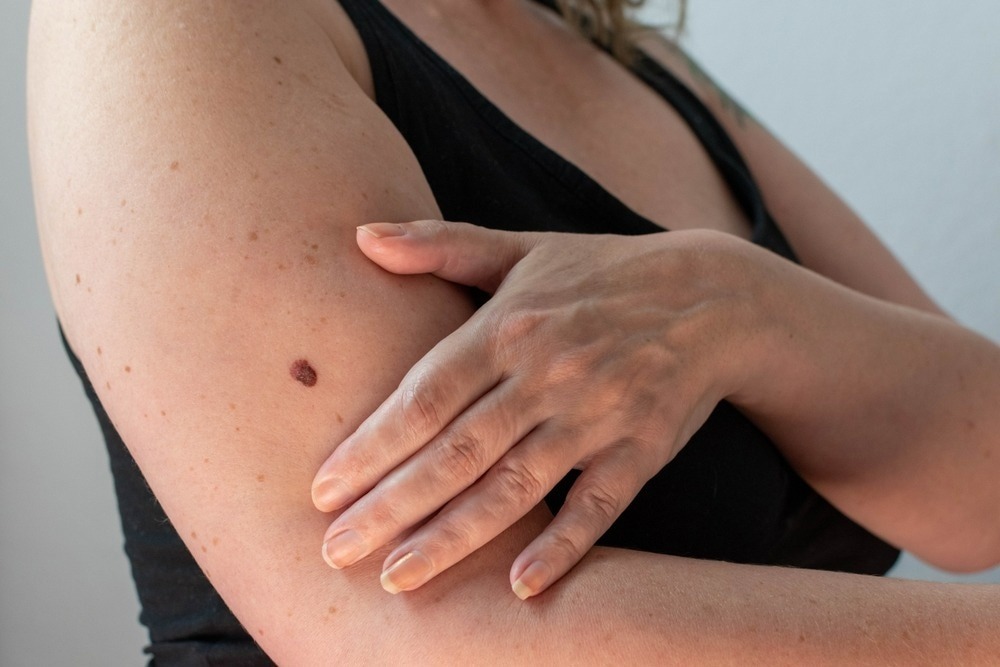 Primary signs of skin cancer ➤ Buzzday.info