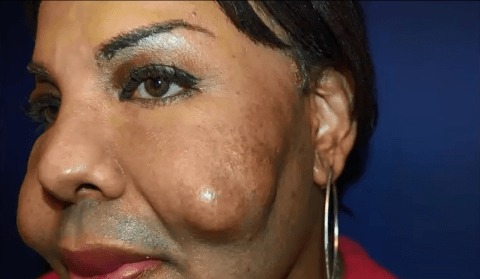 Transformation! Woman Victimized by Black Market Injections Debuts New Look