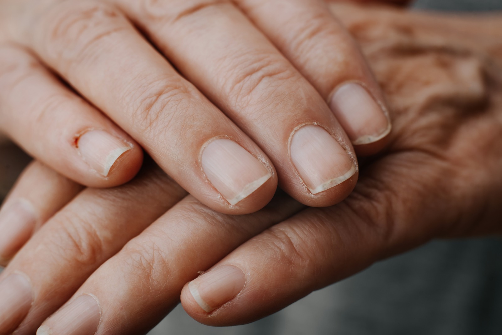 Uitați-vă la unghiile dumneavoastră pentru a vedea dacă aveți semne de cancer ➤ Buzzday.info