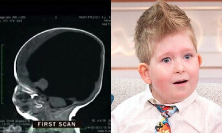 A boy born without a brain has something inside him six years later ➤ Buzzday.info