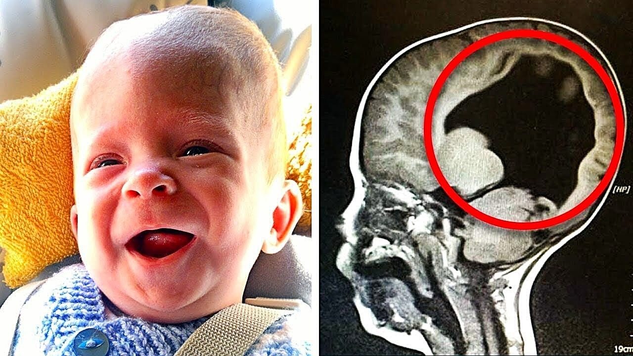 A boy born without a brain has something inside him six years later