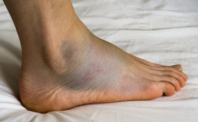 Major Causes Of Swollen Feet ➤ Buzzday.info