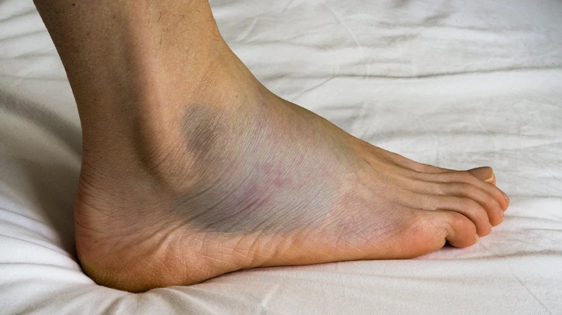 Major Causes Of Swollen Feet ➤ Buzzday.info