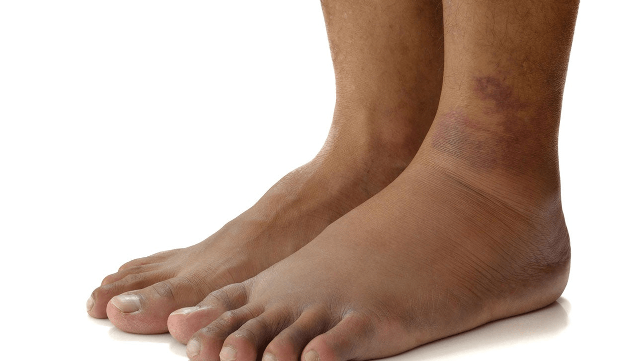 Major Causes Of Swollen Feet