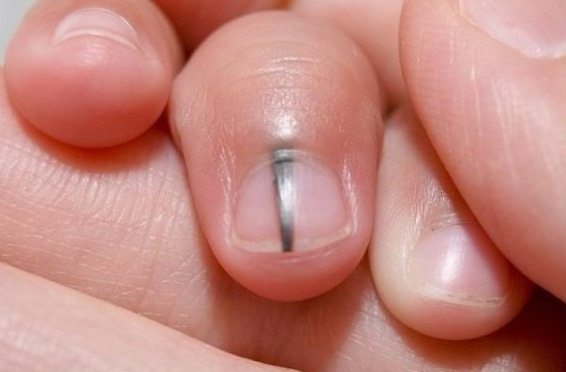 A birthmark called a “line of death” on the nail can be a sign of a serious disease