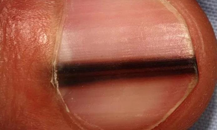 A birthmark called a “line of death” on the nail can be a sign of a serious disease