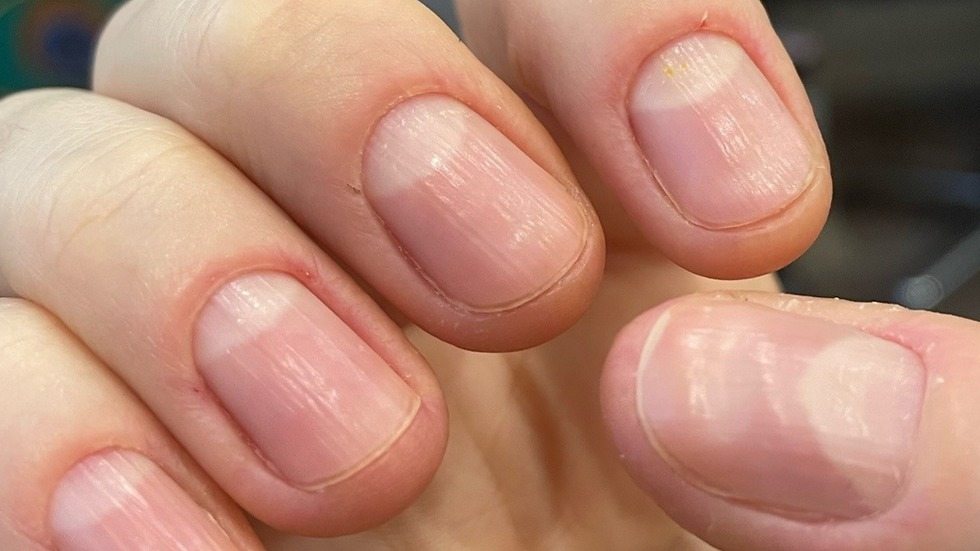 Why nails become ribbed: a vital sign