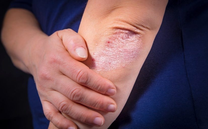 What diseases may be indicated by the presence of rough elbows? ➤ Buzzday.info