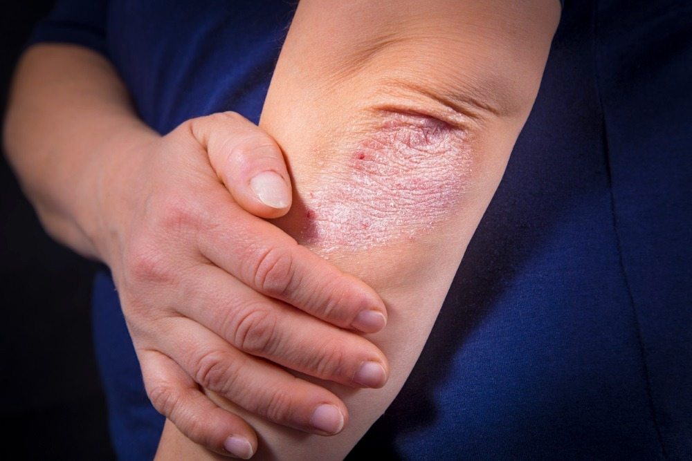 What diseases may be indicated by the presence of rough elbows? ➤ Buzzday.info