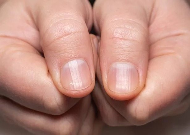 Nail growth rate can show how long you will live