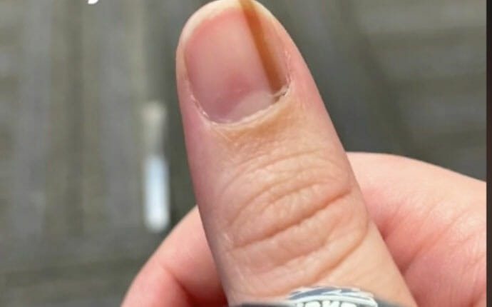 Lekarze nazywają to „linią śmierci”. Gdy pojawi się na paznokciu, nie można już nic zrobić
