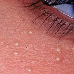 Pourquoi de petites taches blanches apparaissent-elles parfois sur le corps ? Elles peuvent parfois être à l’origine de problèmes graves ➤ Buzzday.info