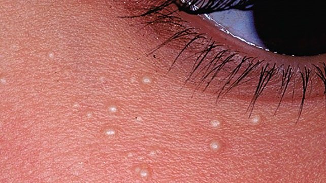 Meaning behind why people sometimes get small white spots across their bodies.They can sometimes have serious problems ➤ Buzzday.info