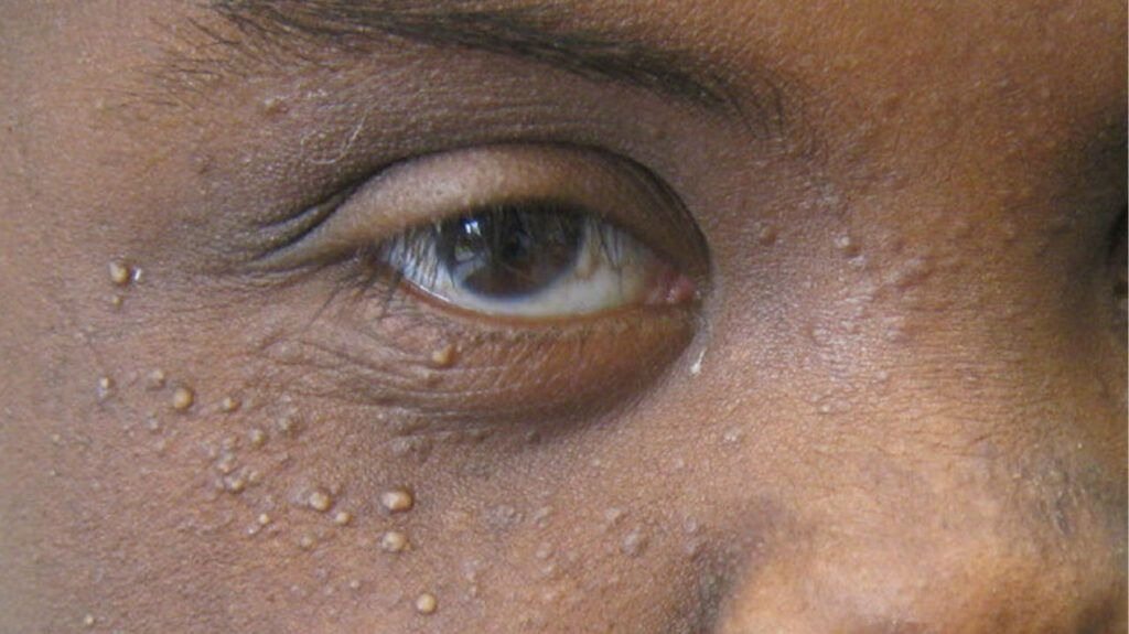 Meaning behind why people sometimes get small white spots across their bodies.They can sometimes have serious problems