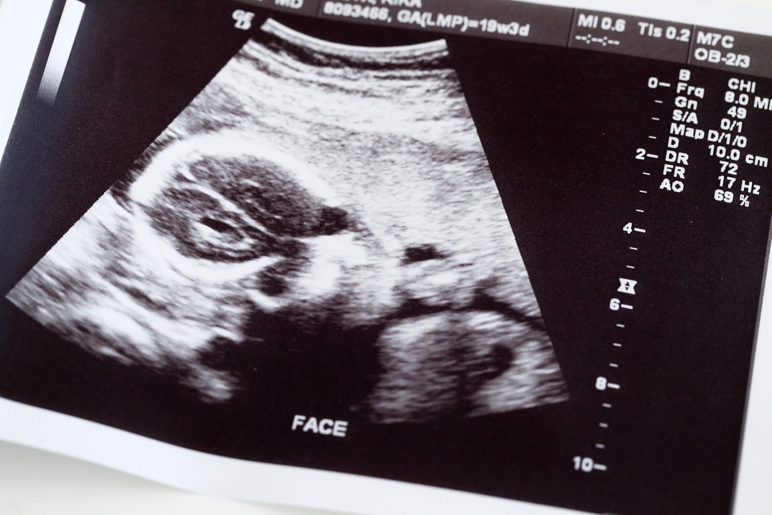 She thought her pregnancy was over. But three weeks later, the doctors discovered something unimaginable