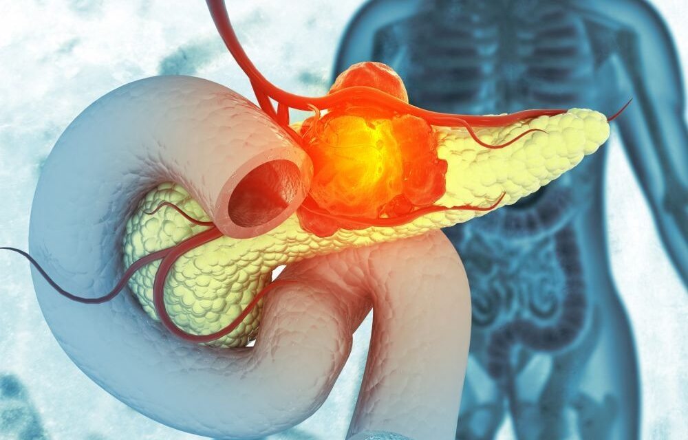 Tak objawia się rak trzustki. Należy zachować szczególną ostrożność