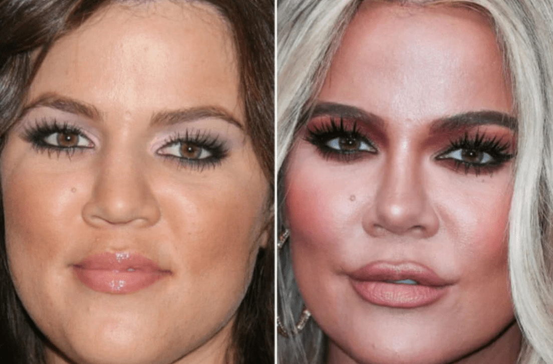 Gwiazdy, których operacje plastyczne wywołały poruszenie: Co mówią eksperci