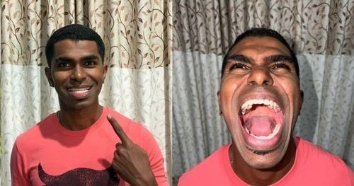 Một người đàn ông Malaysia được phát hiện có 42 chiếc răng—nhiều hơn 10 chiếc so với người bình thường ➤ Buzzday.info