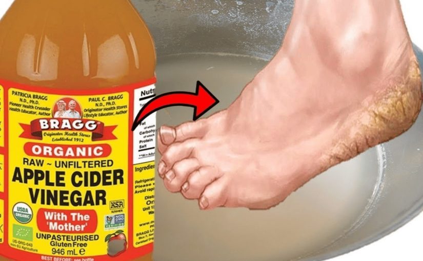 What a Vinegar Foot Bath Can Do ➤ Buzzday.info