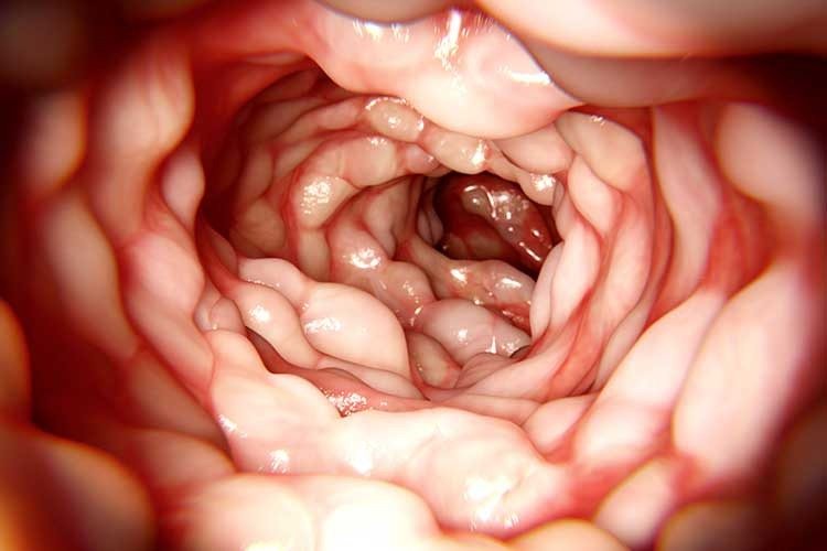 Silent Gut Distress: Early Signs of Crohn’s Disease & Ulcerative Colitis You Should Not Overlook
