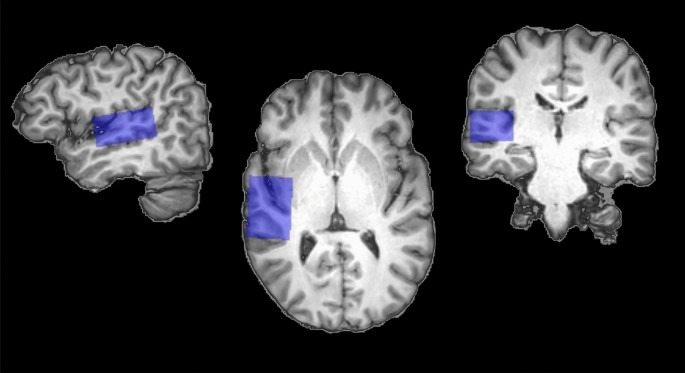 Scientists: Brain Scan Uncovers The Real Root Cause of Tinnitus (Ear Ringing)